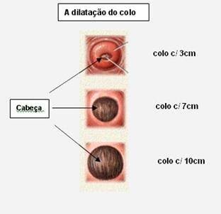 dilatação colo do útero