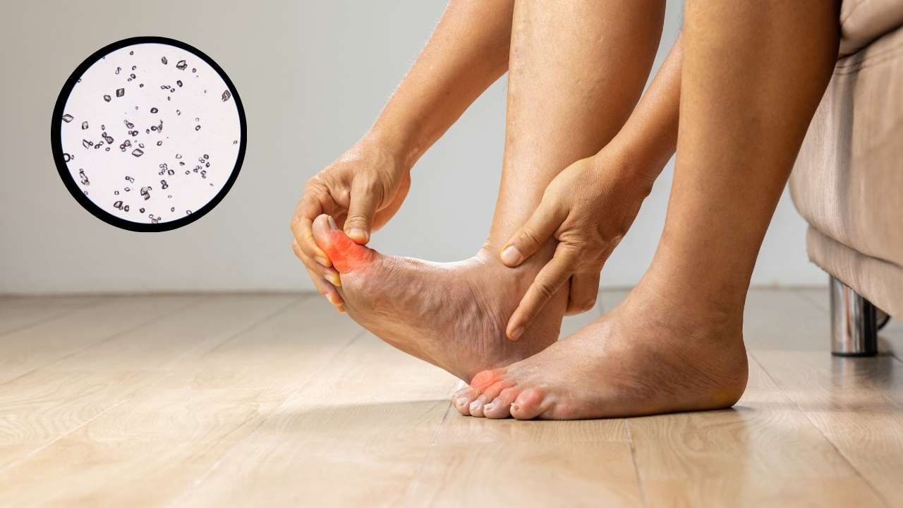 erros comuns ao lidar com ácido úrico alto