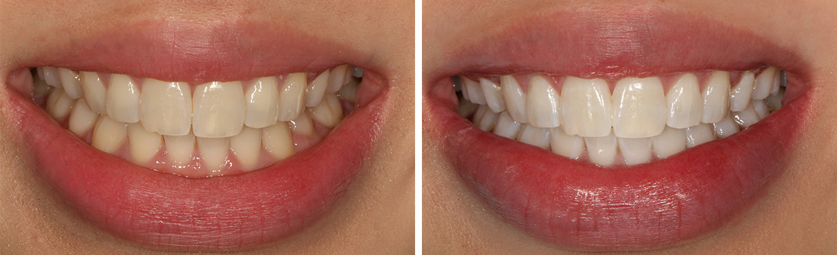 erros comuns ao clarear os dentes em casa