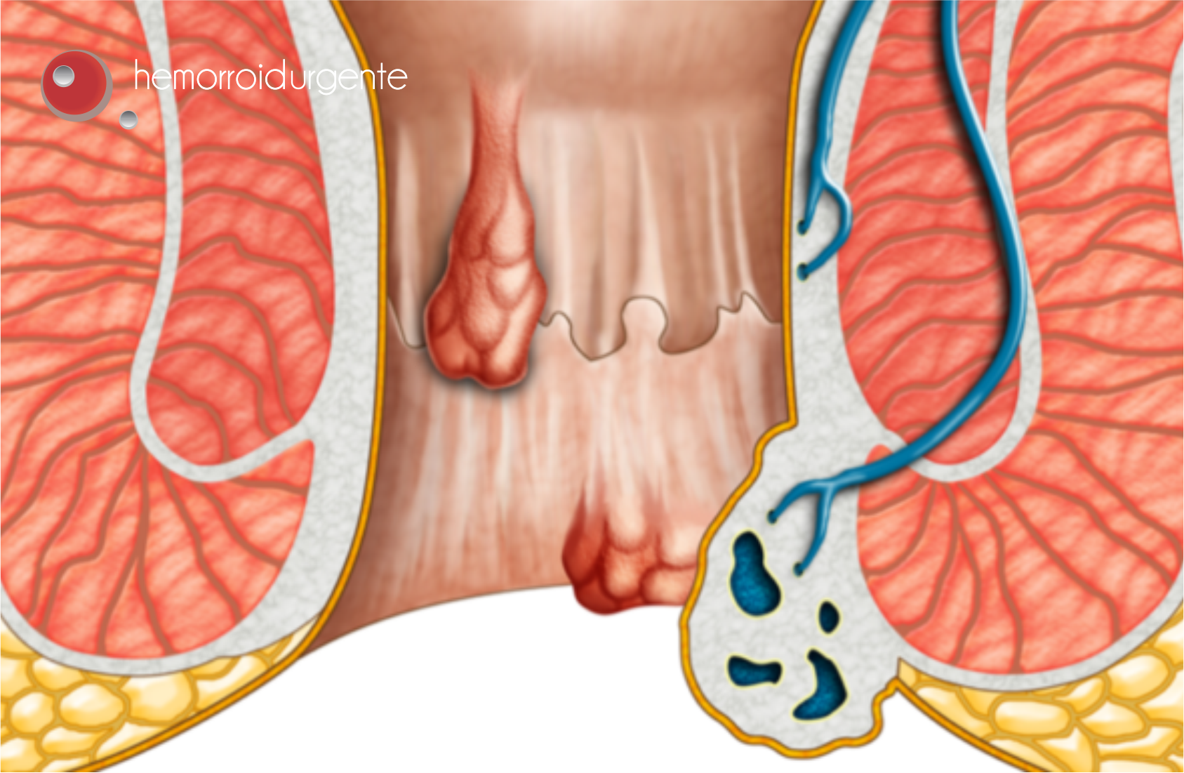 o que significa caroço no ânus tamanho ervilha