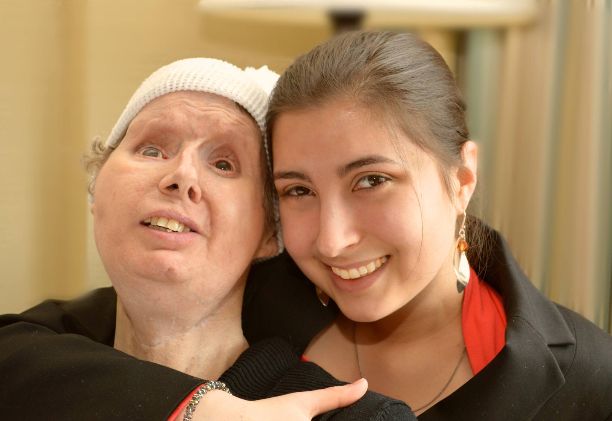 A História Completa de Charla Nash: O Ataque do Chimpanzé Travis e Sua Luta Pela Vida