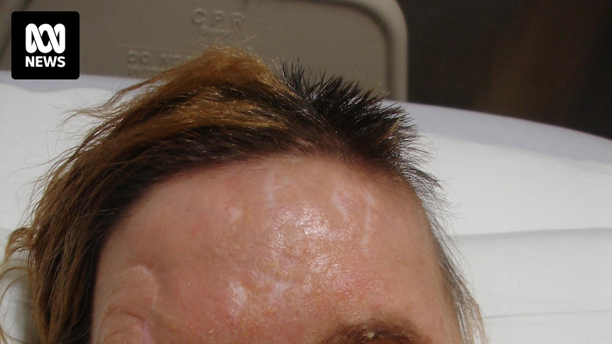 Transplante de Rosto de Charla Nash: Um Marco na Medicina e na Resiliência Humana