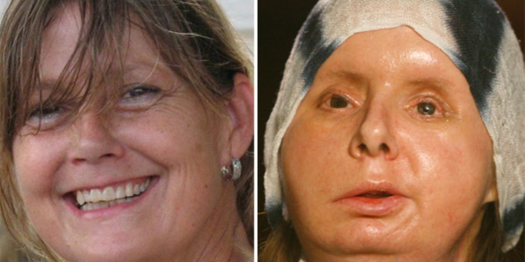 Charla Nash Hoje: Vida Após o Ataque e o Ativismo Contra a Posse de Primatas