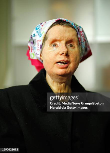 Além do Ataque: Os Desafios Médicos e Pessoais de Charla Nash Após o Transplante