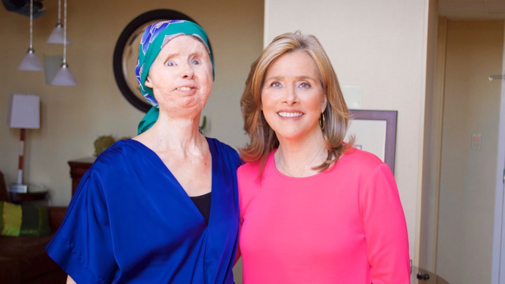 Transplante de Rosto de Charla Nash: Um Marco na Medicina e na Resiliência Humana