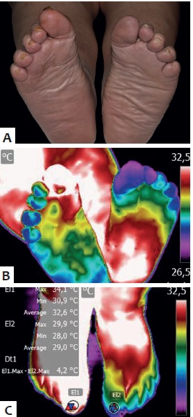 erros comuns ao testar temperatura da água com diabetes