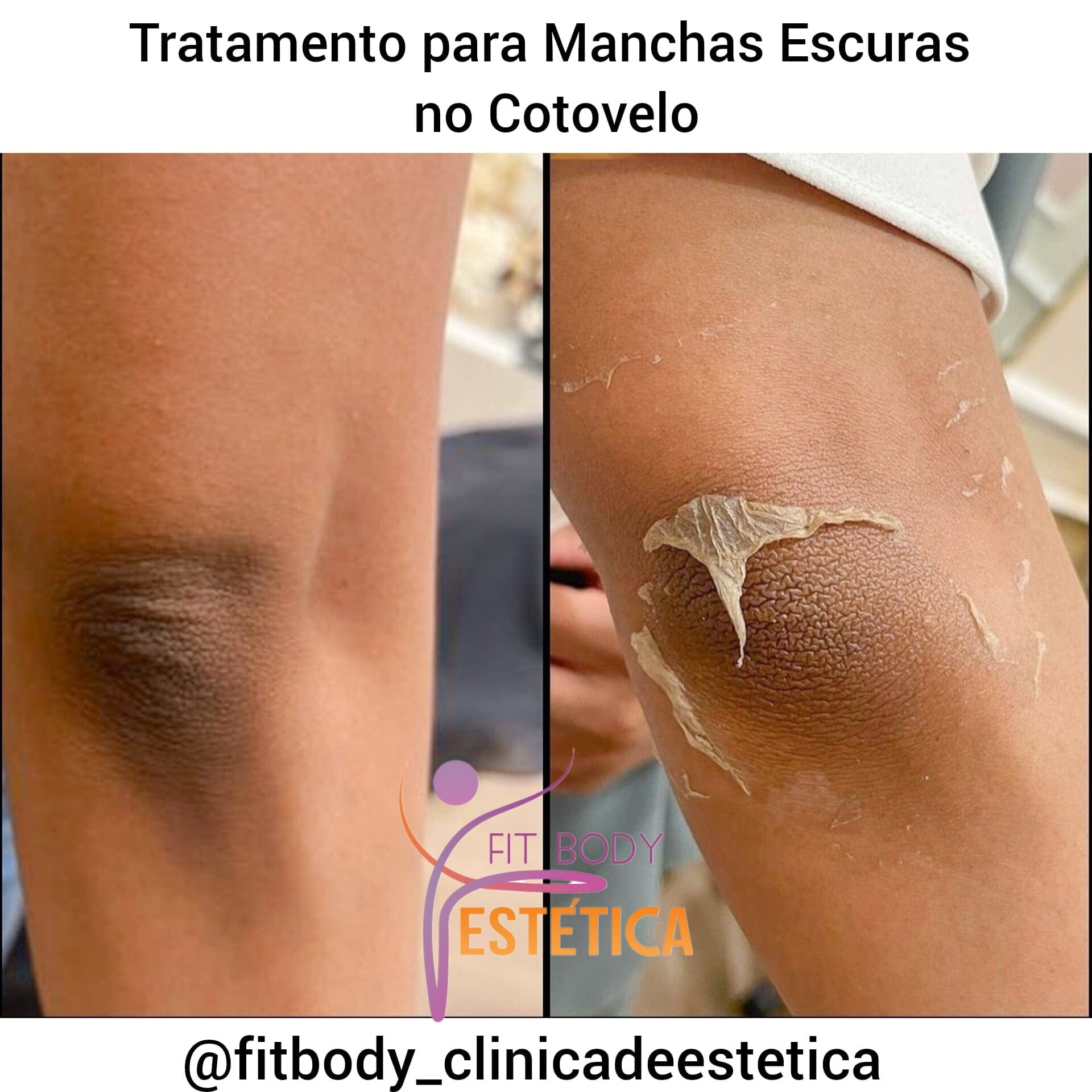 sinais de diabetes na pele