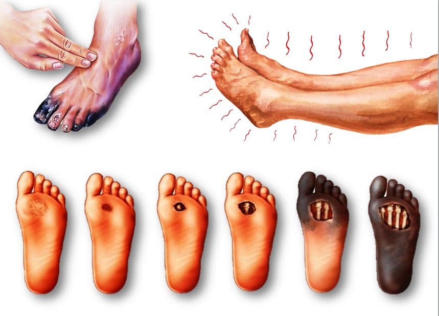 custo tratamento feridas complexas pes diabeticos