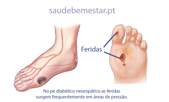 sintomas do pé diabético