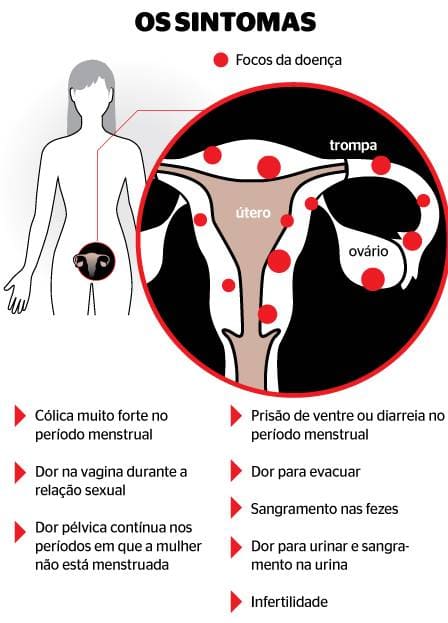 sintomas de endometriose