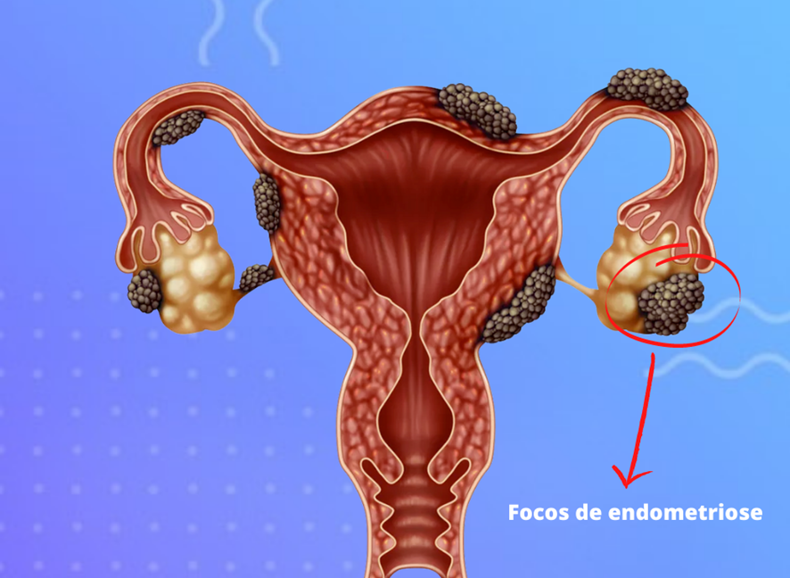 tratamento para endometriose