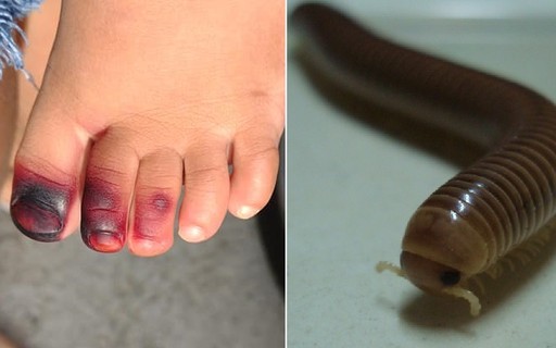 Mitos e Verdades sobre o Gongolo: Ele Realmente Mancha a Pele?