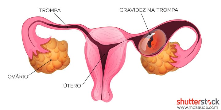 tratamento gravidez ectópica