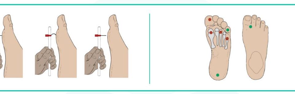 principais erros no autoexame do pé diabético que você deve evitar