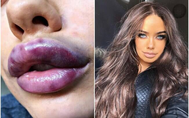 Lábios Roxos por Frio: Entenda as Causas e Como Prevenir