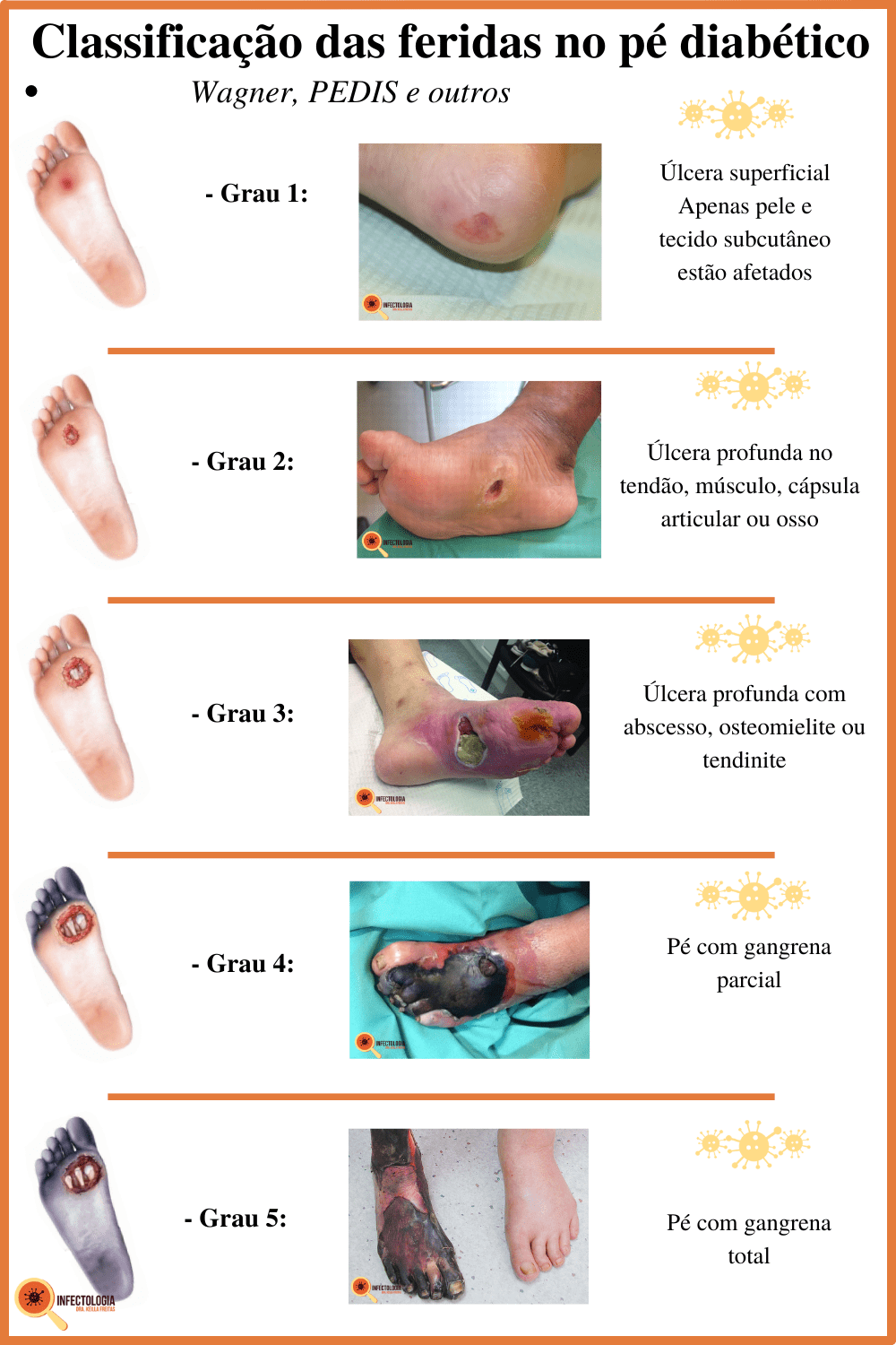7 sinais iniciais neuropatia diabética nos pés que você não pode ignorar