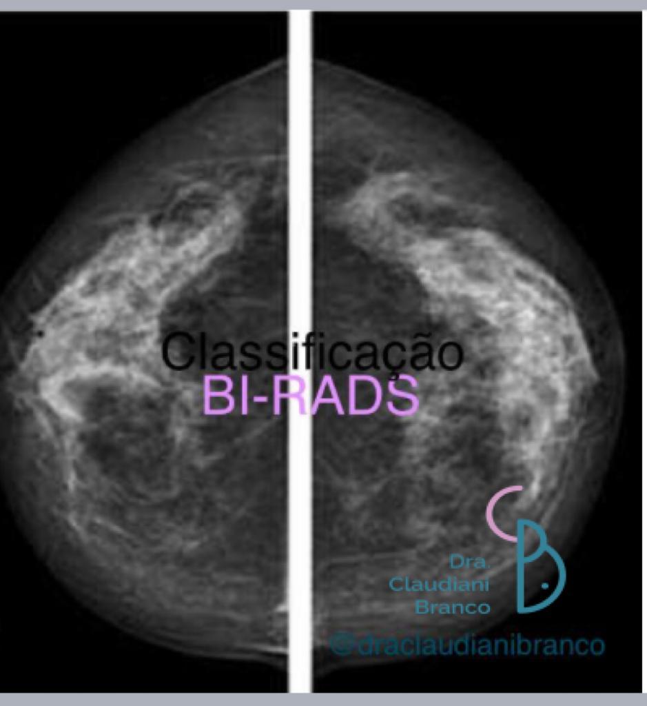 mamografia com achados benignos o que fazer