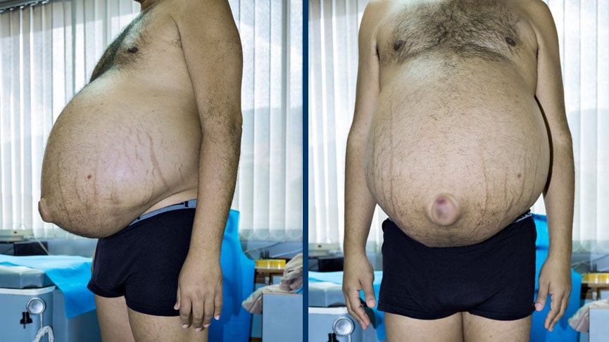 sintomas de barriga d