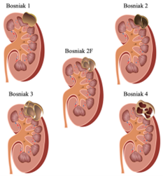 o que é cisto renal