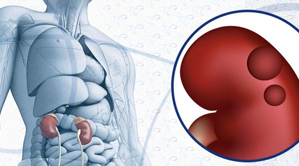 cisto renal benigno