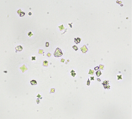 sintomas cristais de oxalato de cálcio