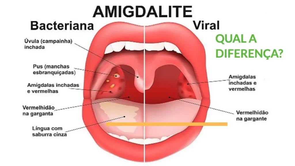 dor de garganta quando é preocupante