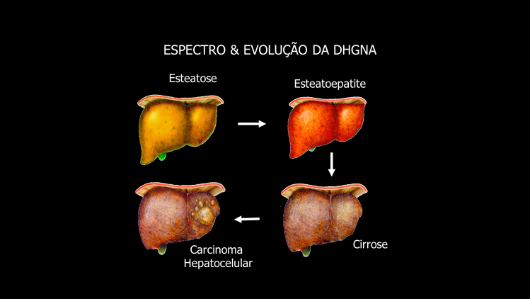esteatose hepática acentuada sintomas