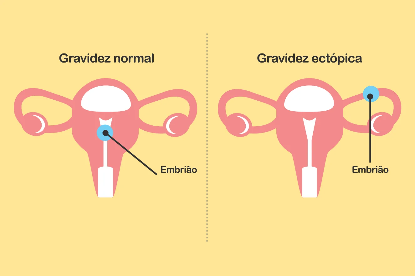 gravidez tópica significado