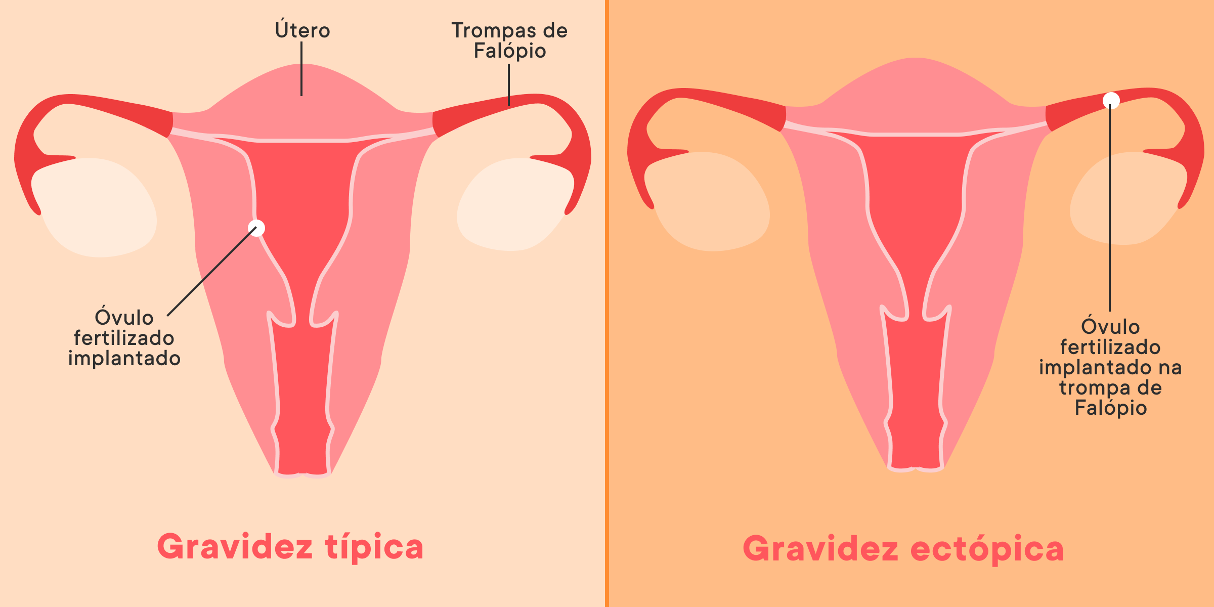 gravidez ectópica e tópica
