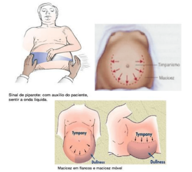 o que é hepatopatia crônica