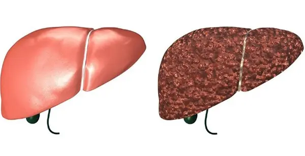 sintomas de hepatopatia crônica