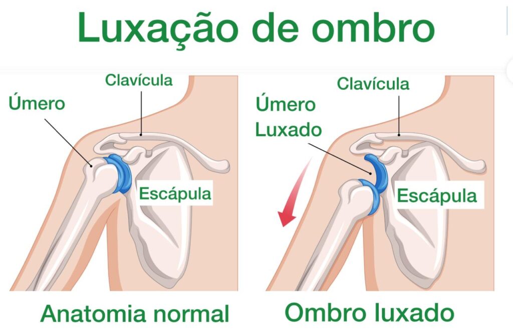 o que significa luxação no ombro