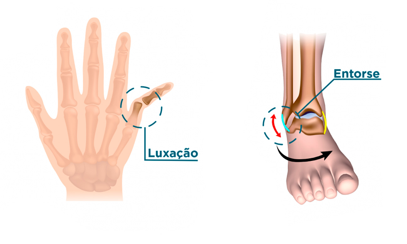 o que significa luxação na patela