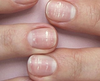 o que são manchas brancas nas unhas