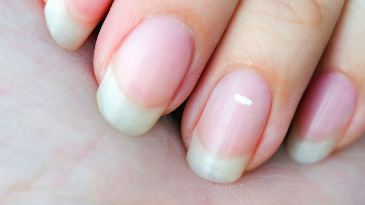 causas de manchas brancas nas unhas