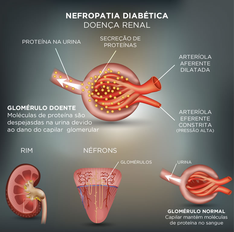 o que é nefropatia