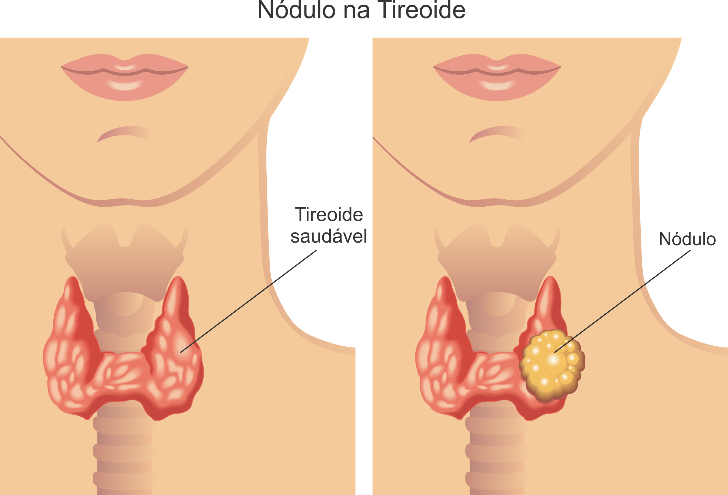 caroço na tireoide