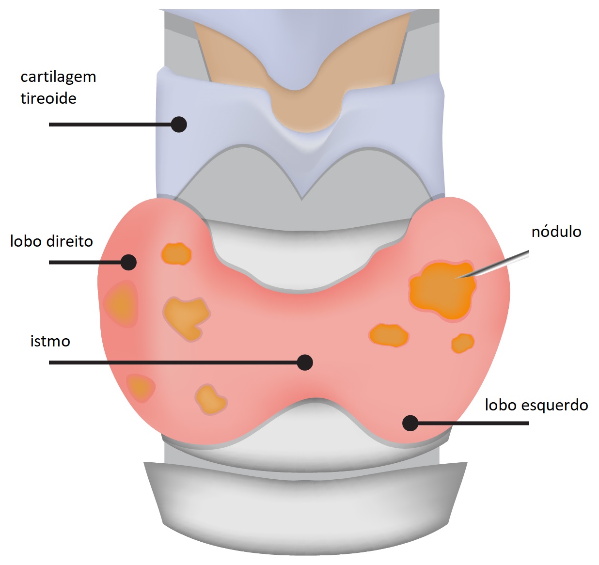 câncer de tireoide
