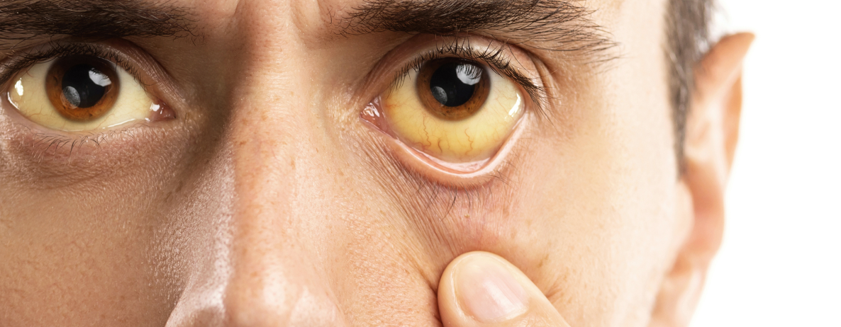 olhos amarelados causas