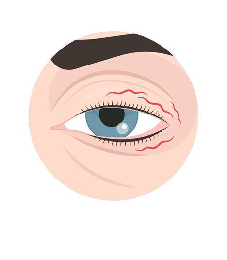 mioquimia palpebral