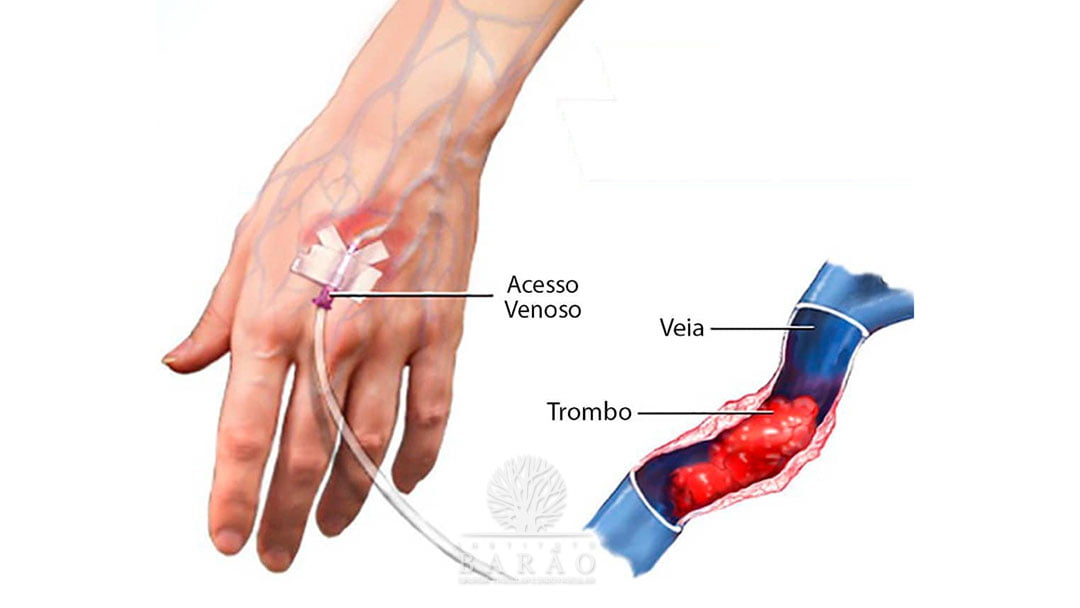 risco de flebite causas