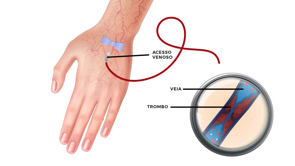 o que é flebite e tromboflebite