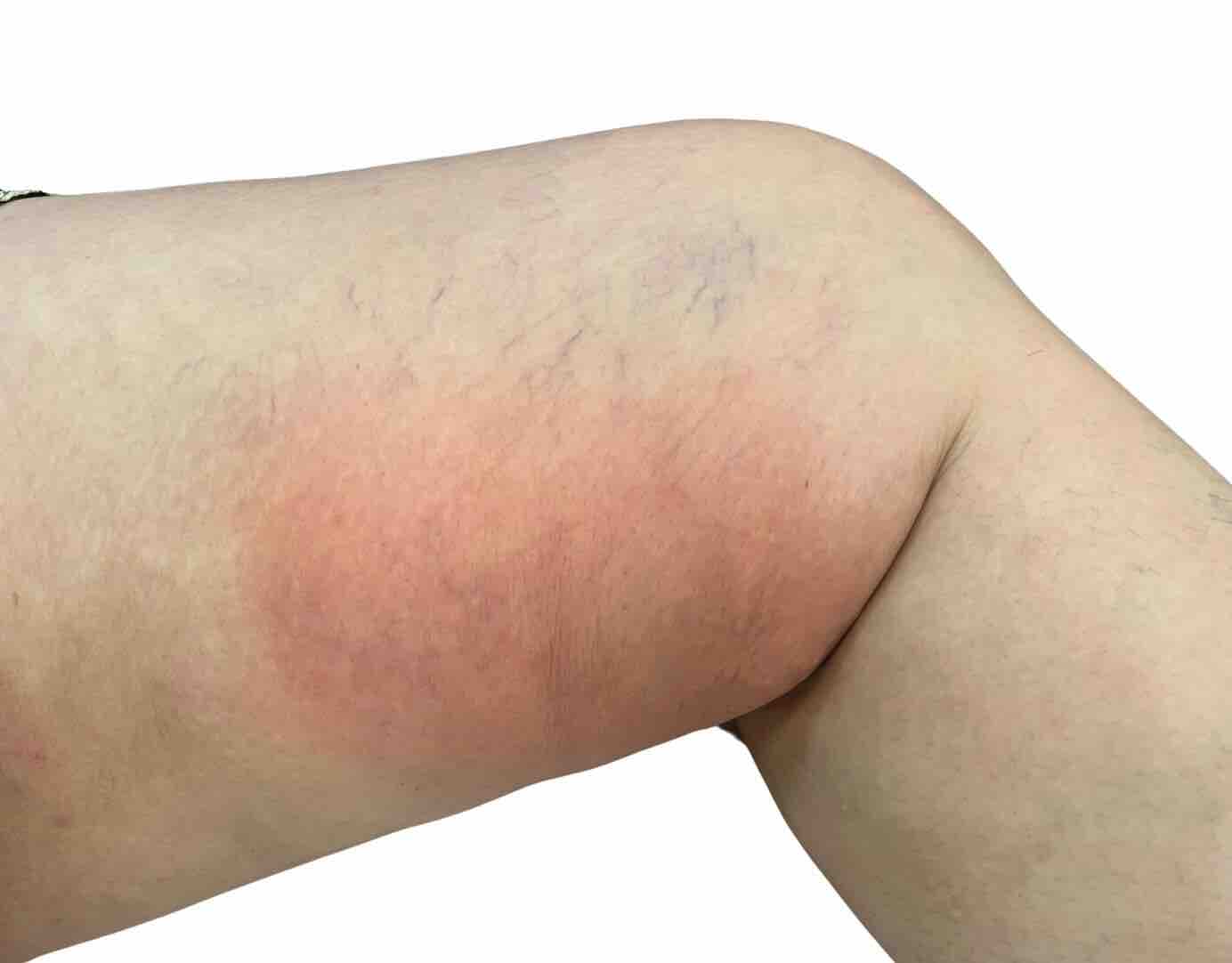 sintomas de flebite em veias