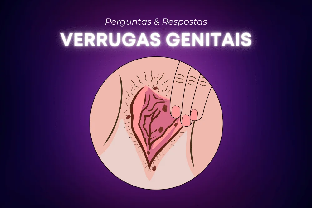 verruga genital o que é