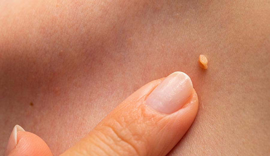 tratamento para verruga genital