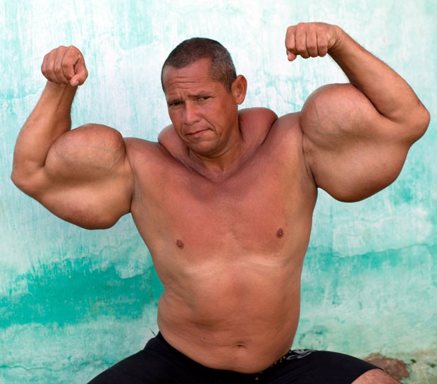 Synthol: O Que É e Por Que Você Deve Evitar