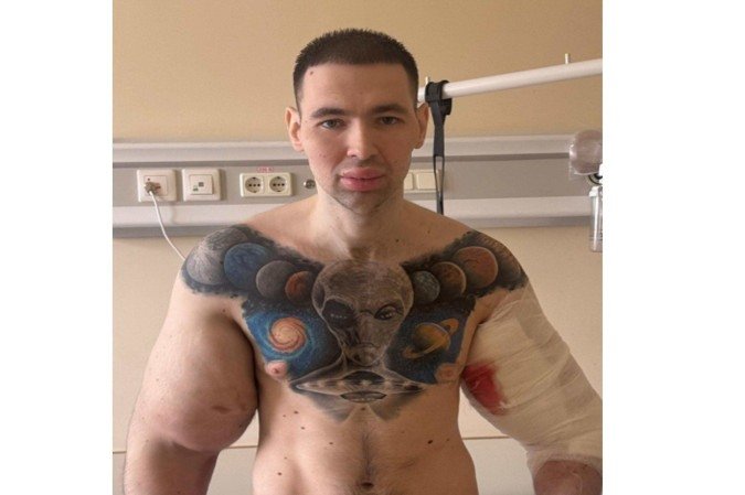 Os Perigos Reais da Injeção de Óleo para Ganho Muscular