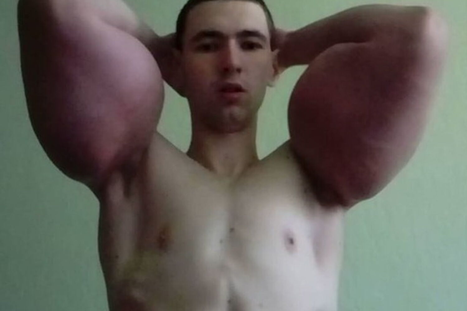 Casos Chocantes de Deformidade por Synthol: Antes e Depois