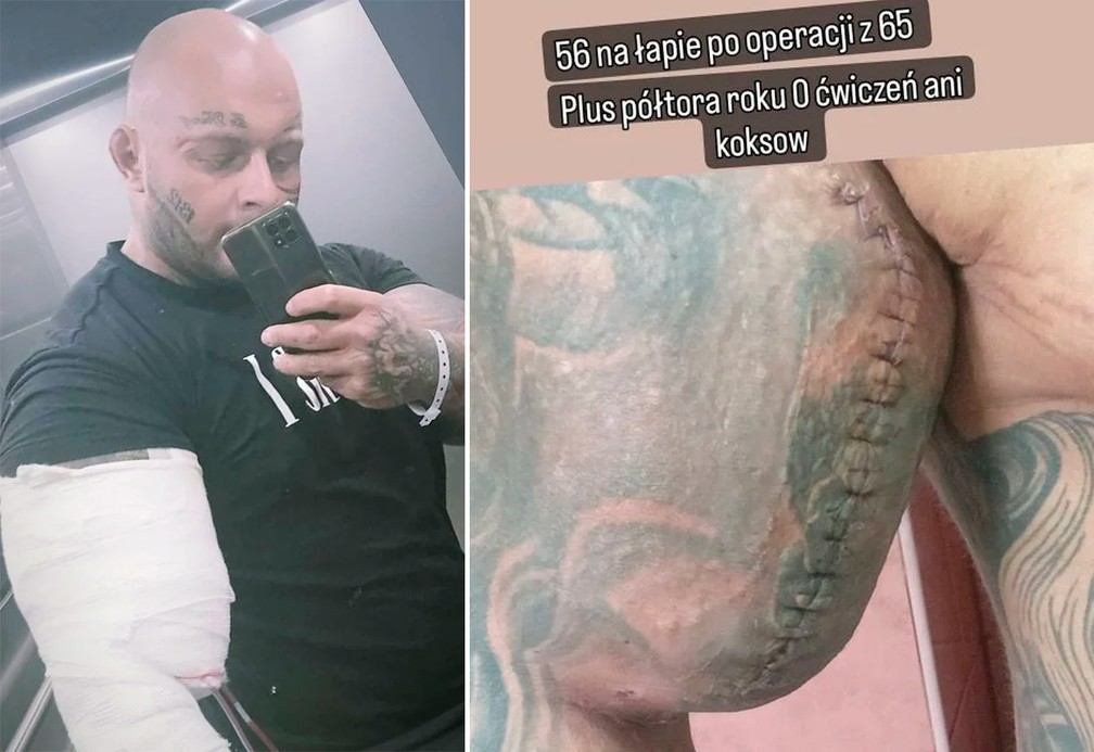 Hipertrofia Saudável: Alternativas Seguras ao Synthol