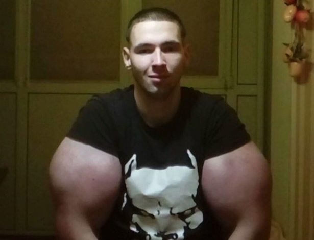 Casos Chocantes de Deformidade por Synthol: Antes e Depois